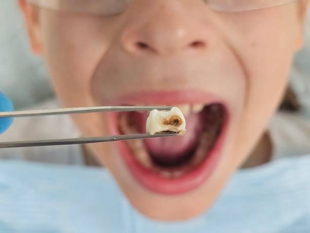 Best Emergency Dentist for Lost Fillings or Crowns in North Adams, MA